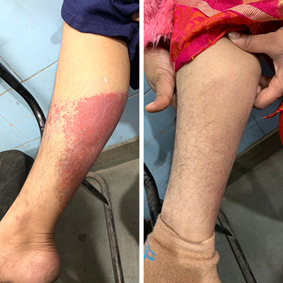 Hypersensitivity Vasculitis